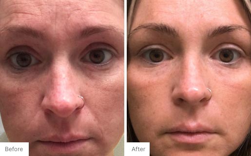 1 - Before and After Real Results image of a woman's face.